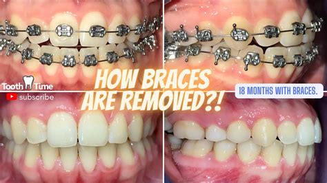 how to remove braces permanently